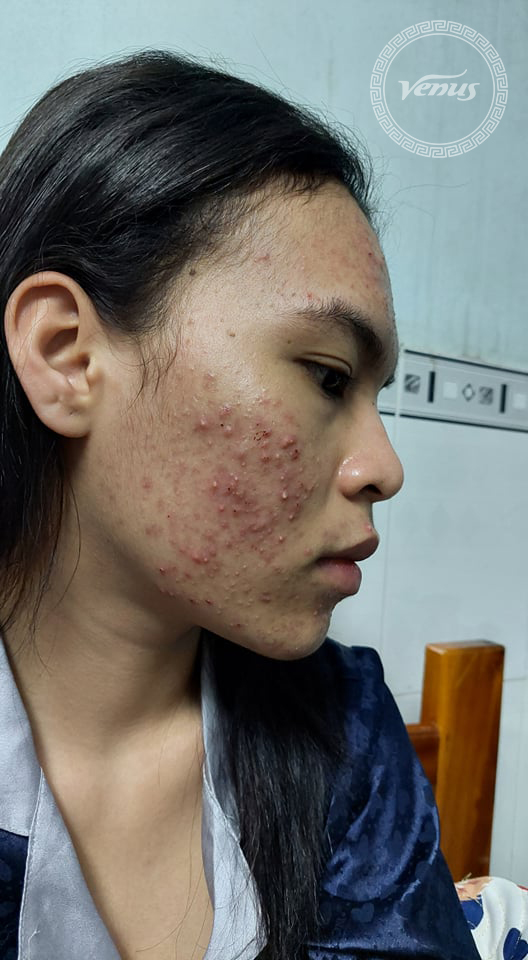 [HCM]Combo Sạch Mụn Thâm Trắng Da Venus