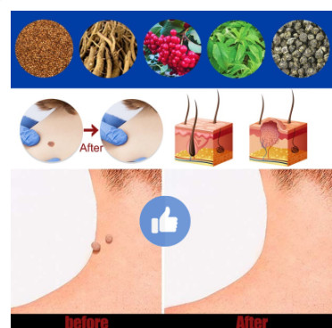 {ĐÁNH BẬT} MỤN CÓC, MỤN THỊT REMOVE EVERY WARTS