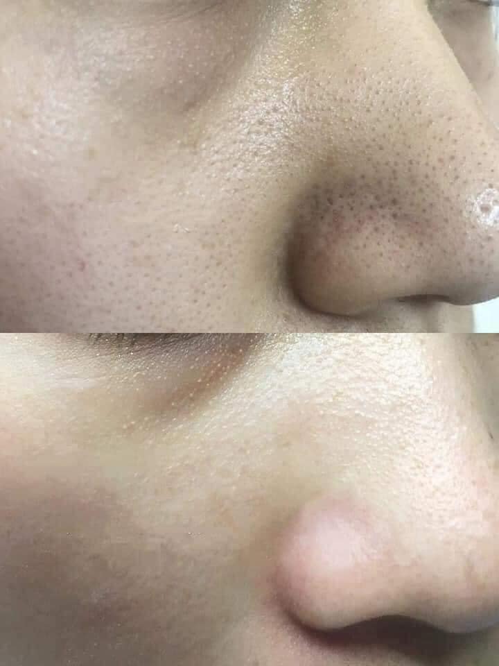 Dung Dịch Ủ Mụn Đầu Đen Medi-peel Extra Super 9 Hàn Quốc 100ml (hàng công ty)