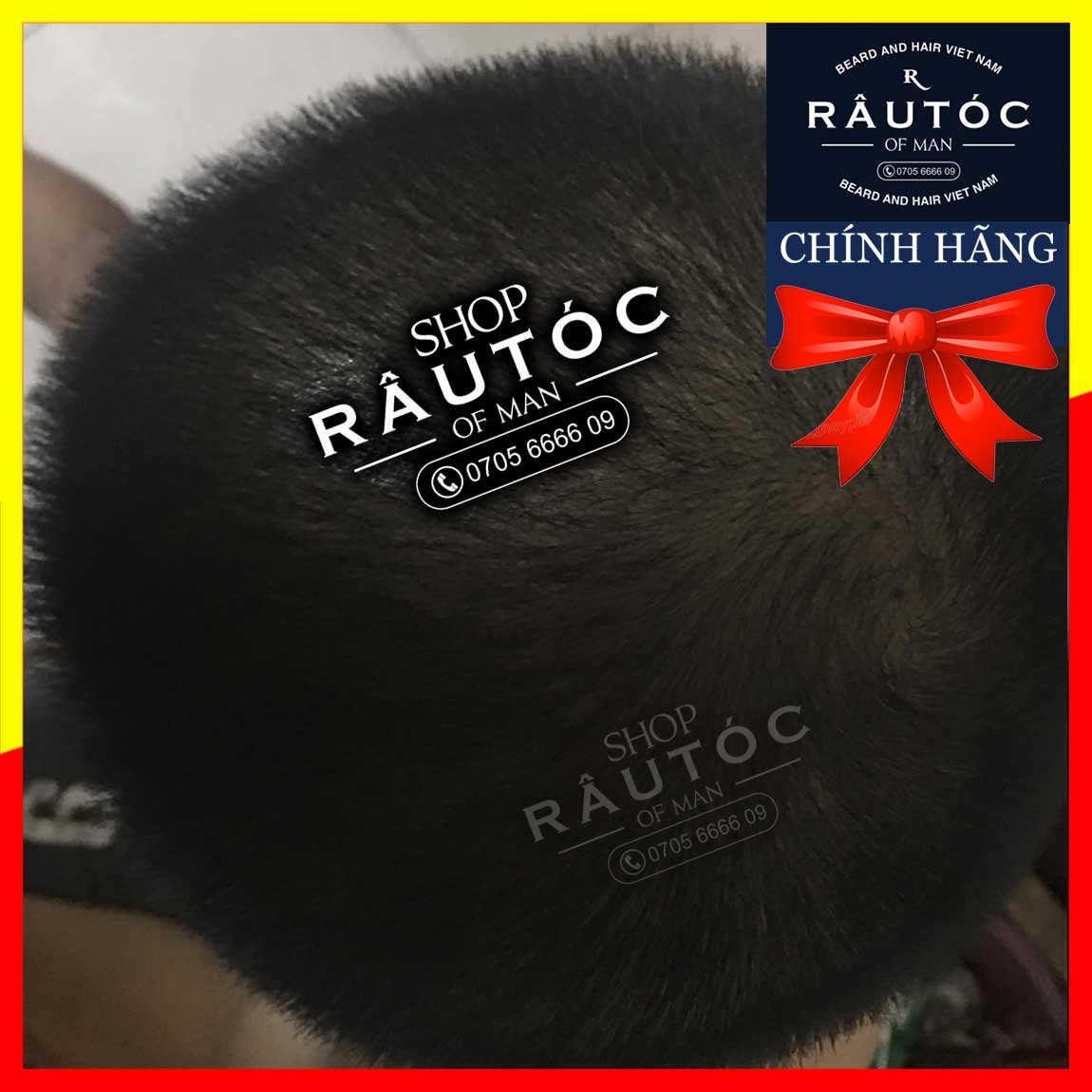 PEO MIX pha vào Minoxidil 5%