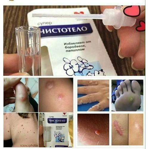 GEL XÓA NỐT RUỒI, THỊT THỪA, MỤN CÓC