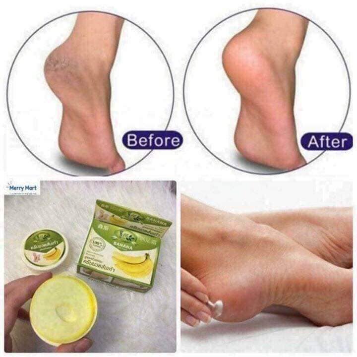KEM CHUỐI Bôi Nứt Gót Chân Thái Lan