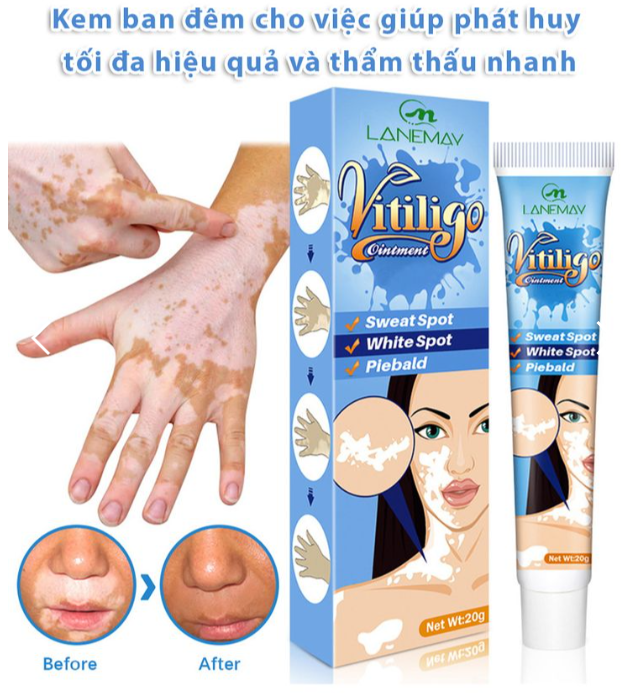 Kem lang ben thảo mộc VITILIGO