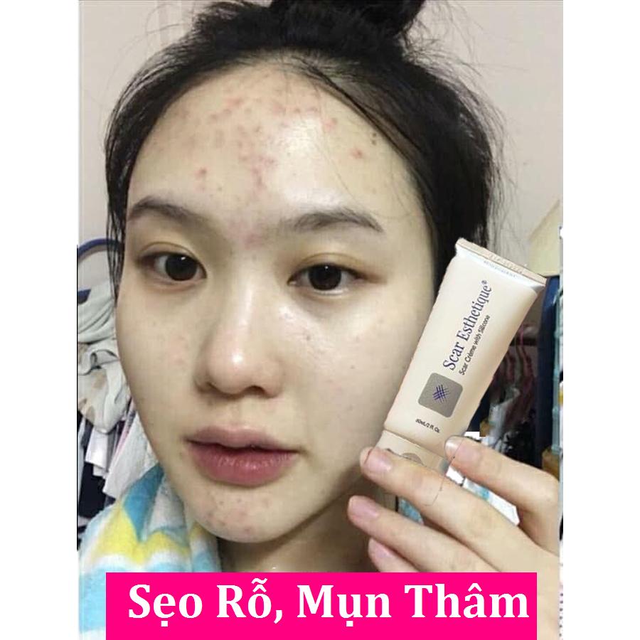 Kem sẹo rỗ/lõm/thâm Scar Esthetique 10g
