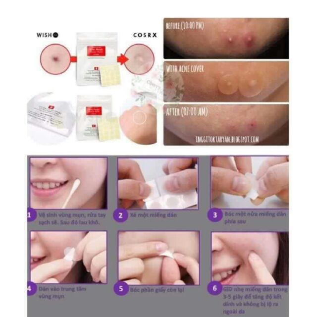 Miếng dán mụn Acne, sản phẩm tốt, chất lượng cao, cam kết sản phẩm nhận được như hình và mô tả