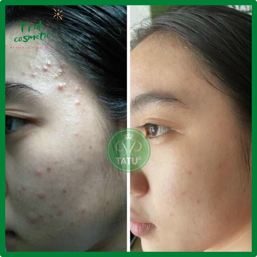 [Chính hãng] Kem chấm mụn mờ thâm, giảm nhanh mụn viêm, mụn thâm