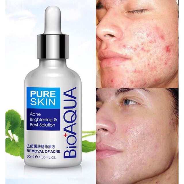 Combo Bộ  Mụn Thần Thánh Bioaqua
