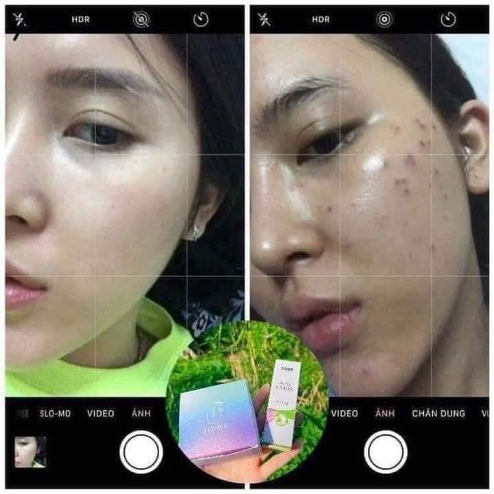 [HCM]SERUM JIUHE MỤN ACNE EXTRA THANH TÔ