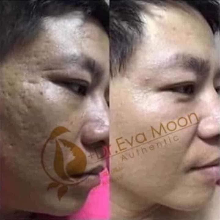 Cao sẹo collagen Dr Eva Chính Hãng