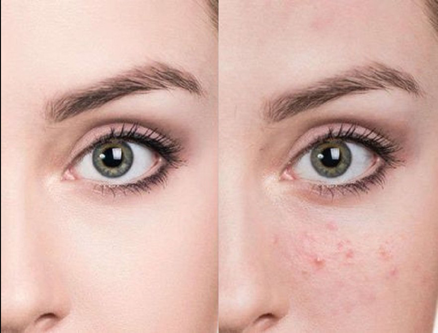 Serum Ngừa Mụn Thâm Trắng Da Linh Chi Đỏ 10ml