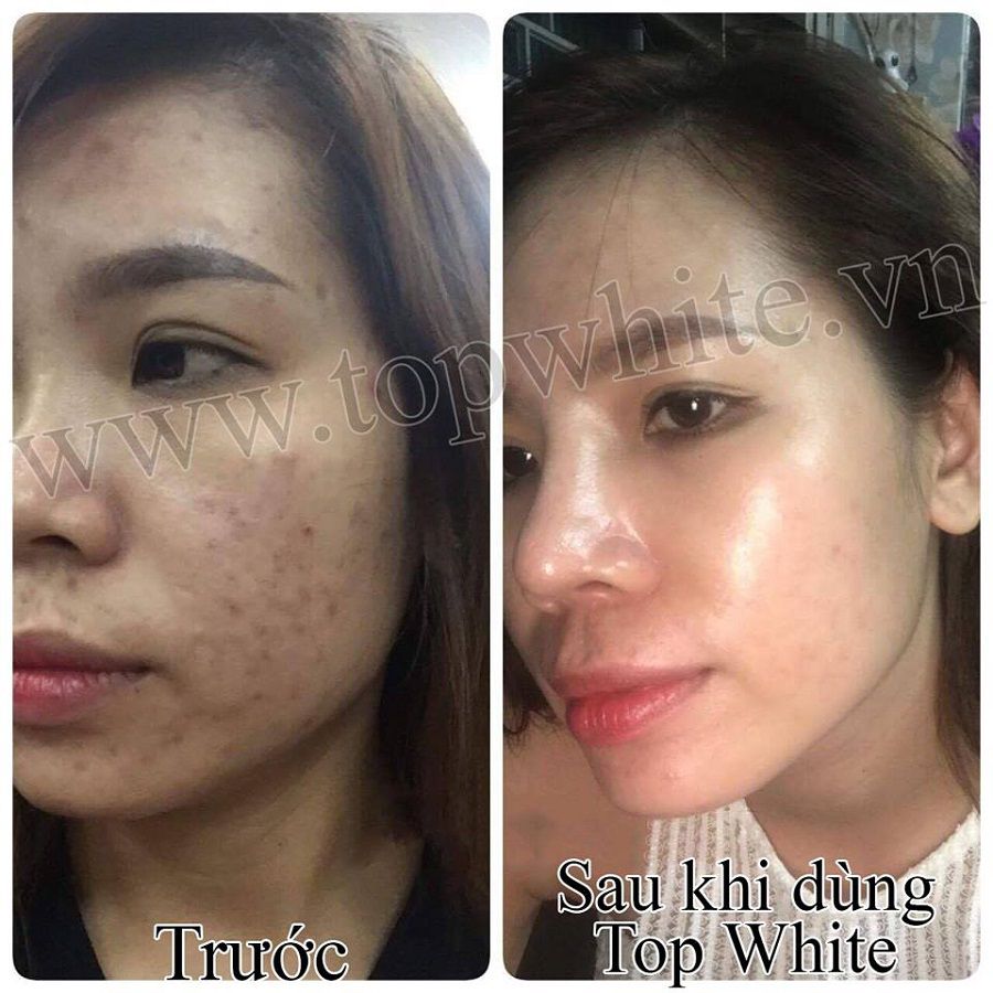Sữa Rửa Mặt Top White D5