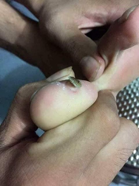 Tinh Chất Bôi Mụn Cóc Ibokorori Nhật Bản