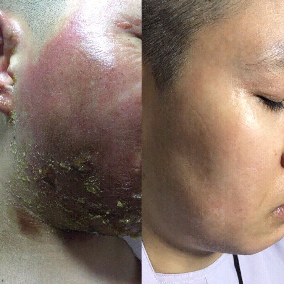 [HCM]Medigen – Dịch chiết Tế bào gốc trẻ hoá da