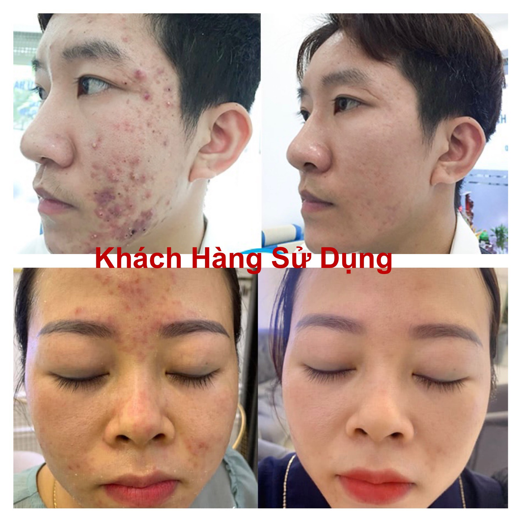 Mặt nạ gói Ngọc Sâm - Ngừa Mụn Trắng Da