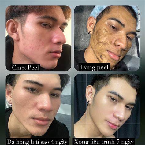 Peel Da vi tảo 7 ngày đẹp (1  bo)