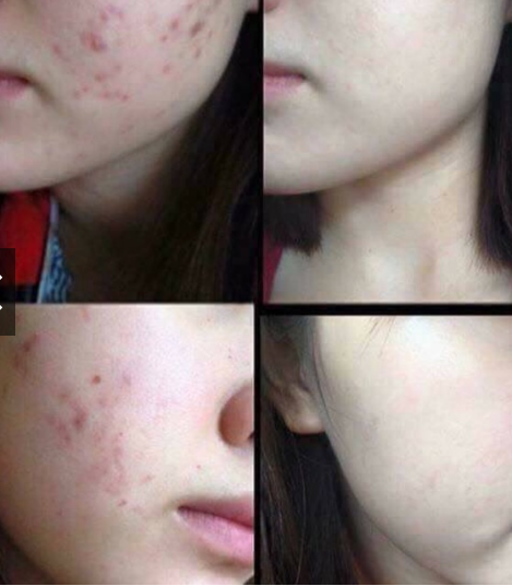 [HCM]Serum xóa tan vết thâm mụn  sẹo rỗ lâu năm An Dược Sơn chai 30ml
