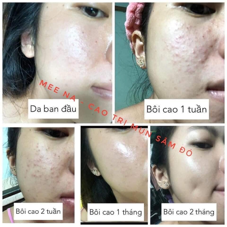 Cao Mụn Sâm Đỏ 36 Vị Meea Organic Giảm Mụn Mờ Thâm 15g