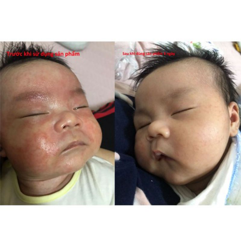 Kem chàm sữa Kutieskin chữa chàm sữa, mụn sữa, viêm da cơ địa cho bé từ sơ sinh (Tuýp 30g)