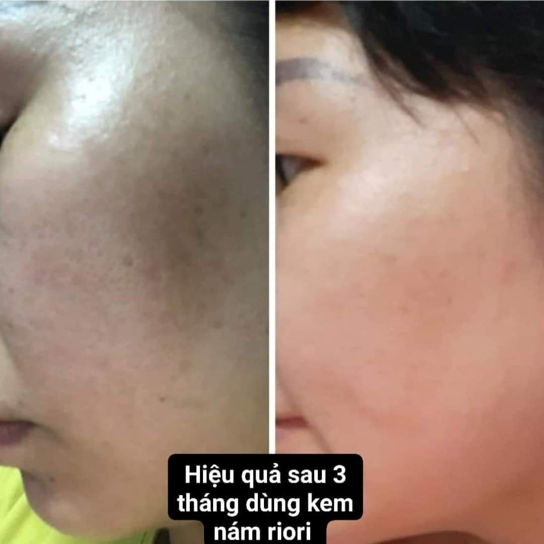 Kem nám da Riori Melasma Collagen 30g