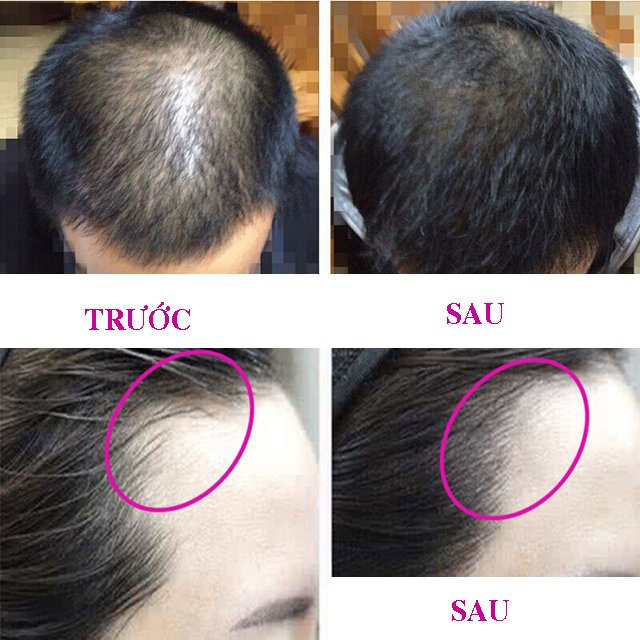 Tinh Dầu Thảo Mộc Chống Rụng Tóc Kích Thích Mọc Tóc Từ Nhân Sâm 30ml