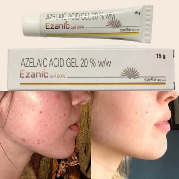 Gel giảm mụn, mờ thâm Azelaic Acid Gel 20% 15 gram