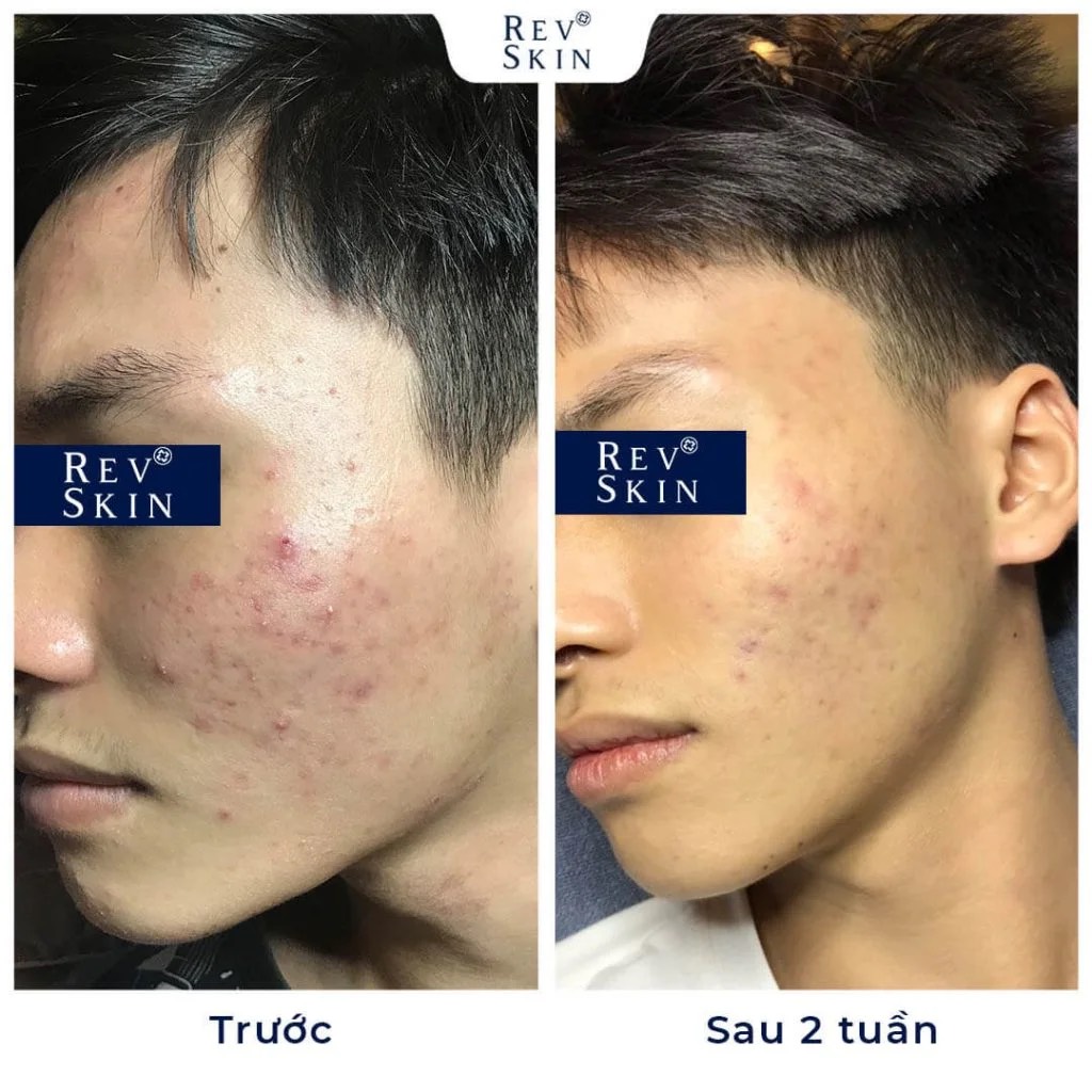 Sữa Rửa Mặt trị mụn REVSKIN DEEP CLEANSER - Dolly Beauty