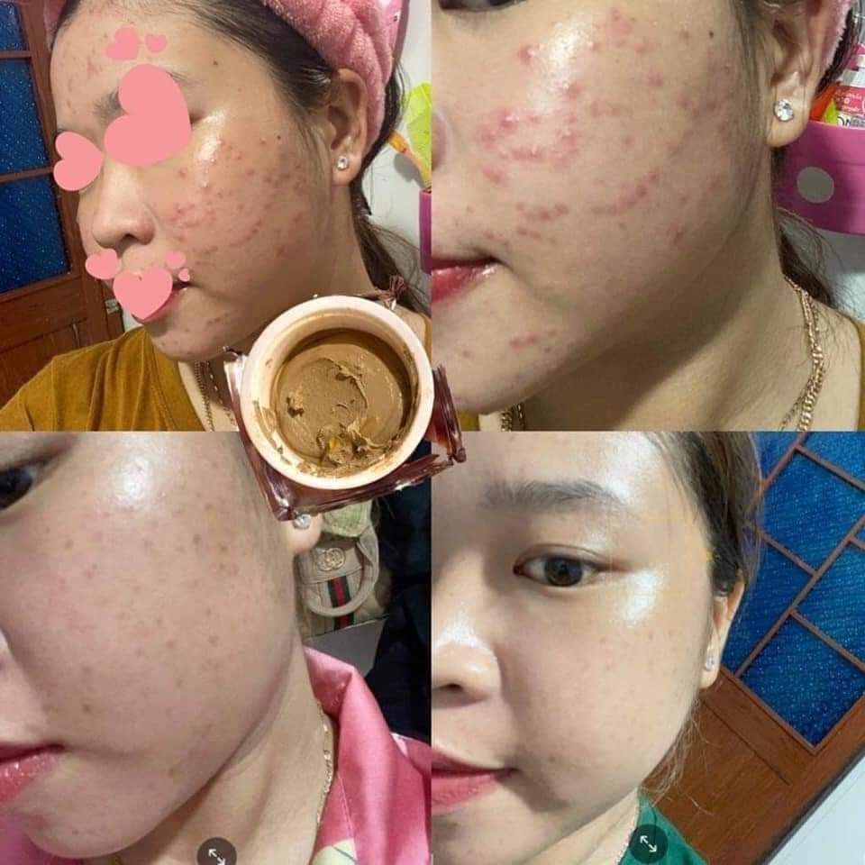 Combo Cao Mụn Sâm Đỏ 15gr và Sữa Rửa Mặt Nhân Sâm - chính hãng