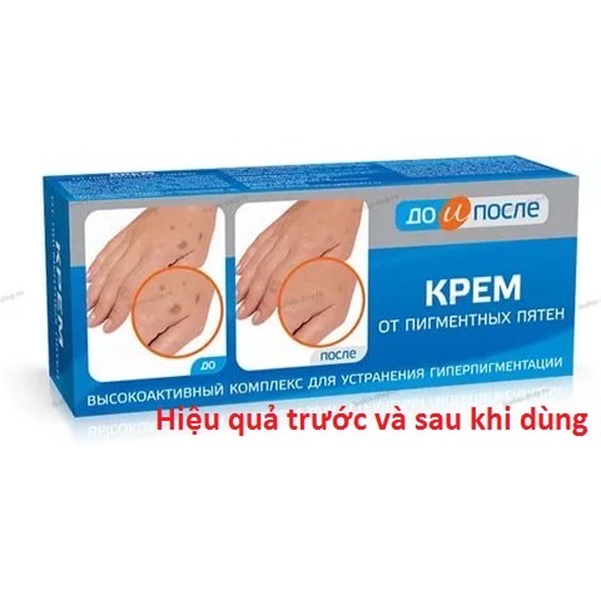 [HCM]Kem bôi mờ đồi mồi Nga Kpem