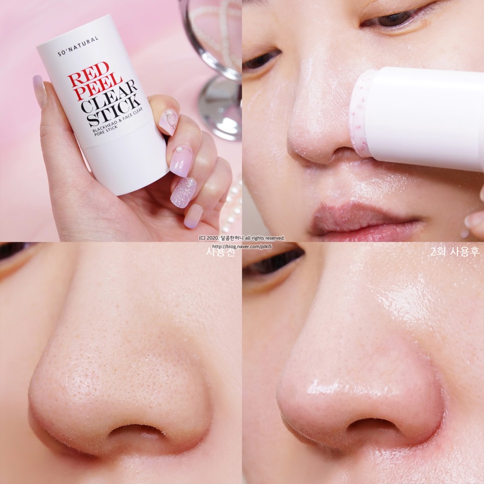 THANH LĂN GIẢM MỤN ĐẦU ĐEN [So’Natural Red Peel Clear Stick]