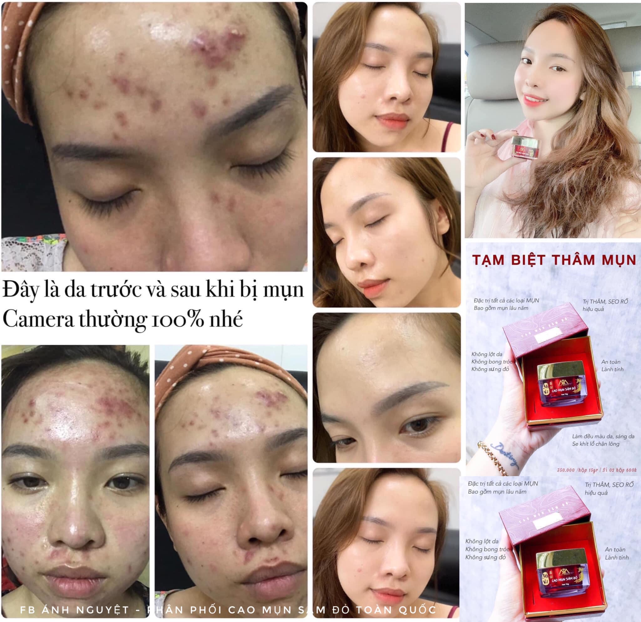 [HCM] (Mới) Cao Mụn Sâm Đỏ 36 Vị (Hộp 15g) Date Mới - Meea Organic