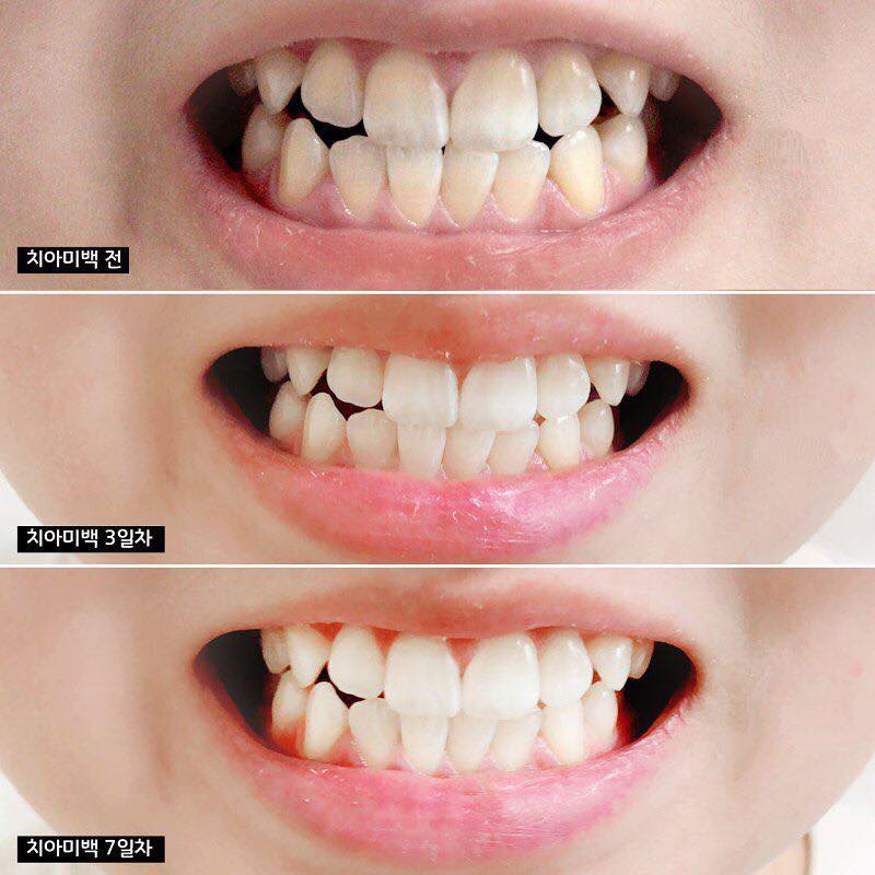 Kem đánh răng Median Dental IQ 93- - 120g