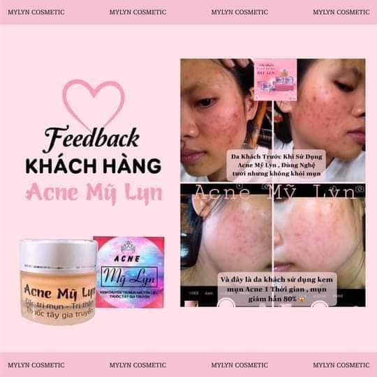 Kem Acne Mỹ Lyn 5gram (Hủ nhỏ vuông)