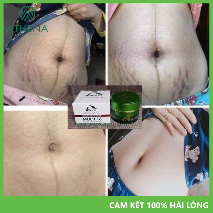Kem Rạn Da Multi 16 TẶNG HÔI NÁCH Athena, Làm Mờ Rạn Da Hiệu Quả N.hất