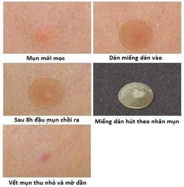 MIẾNG DÁN MỤN MAYAN CARE  ( HỘP/20 MIẾNG)