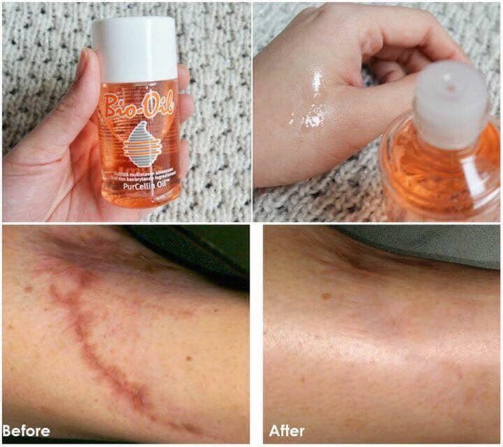 BIO OIL - TINH DẦU CHỐNG RẠN DA 60ml