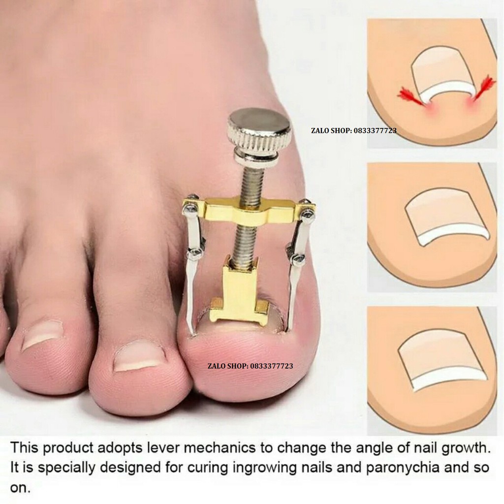 dụng cụ chữa quặp móng chân khỏi đau do móng đâm vào thịt