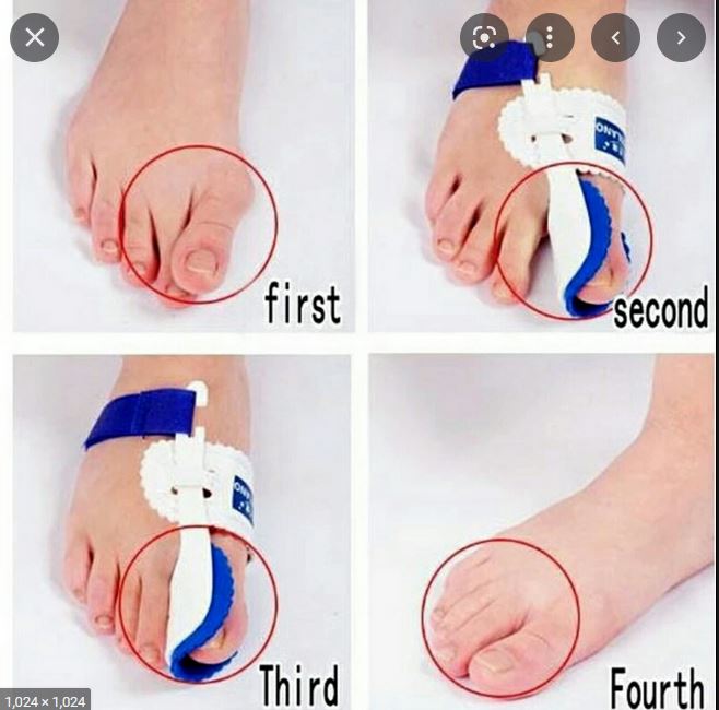 dụng cụ nẹp định hình ngón chân