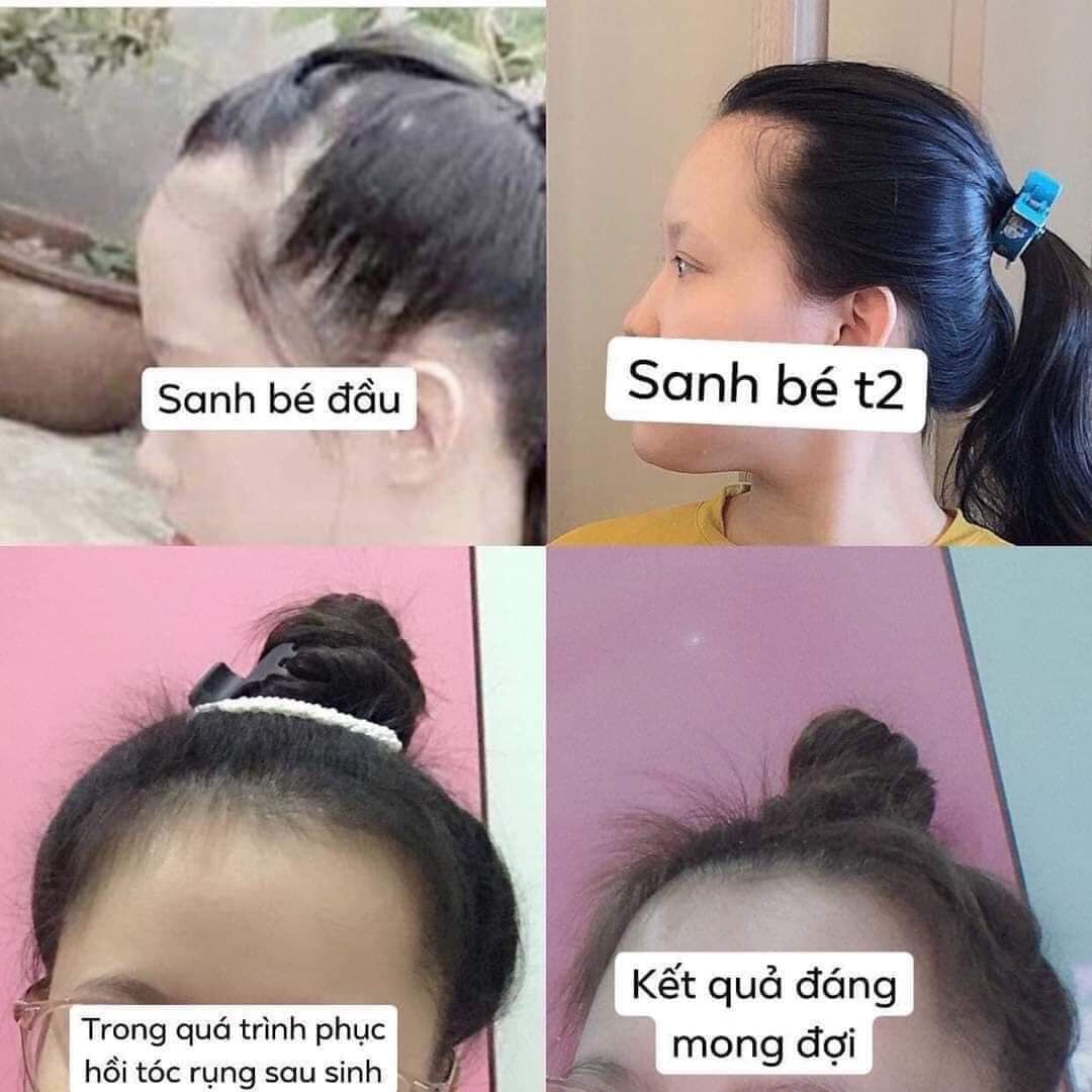 Xịt thảo dược kích mọc tóc