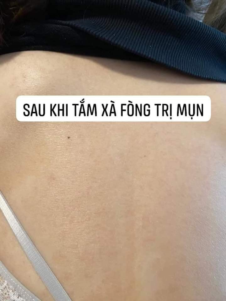 (Chuẩn Auth) Xà Phòng Loại Bỏ Mụn Lưng Tar NC Nga
