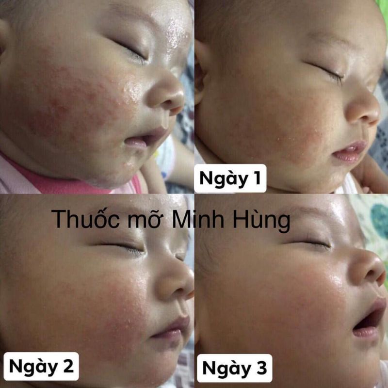 Kem mỡ, kem bôi da Minh Hùng ( Hàng công ty 100% )