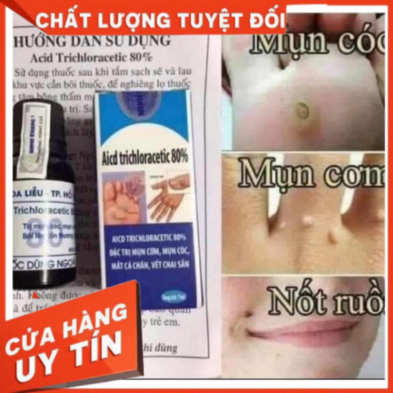 MỤN CÓC, MỤN CƠM , CHAI MẮT CÁ CHÂN