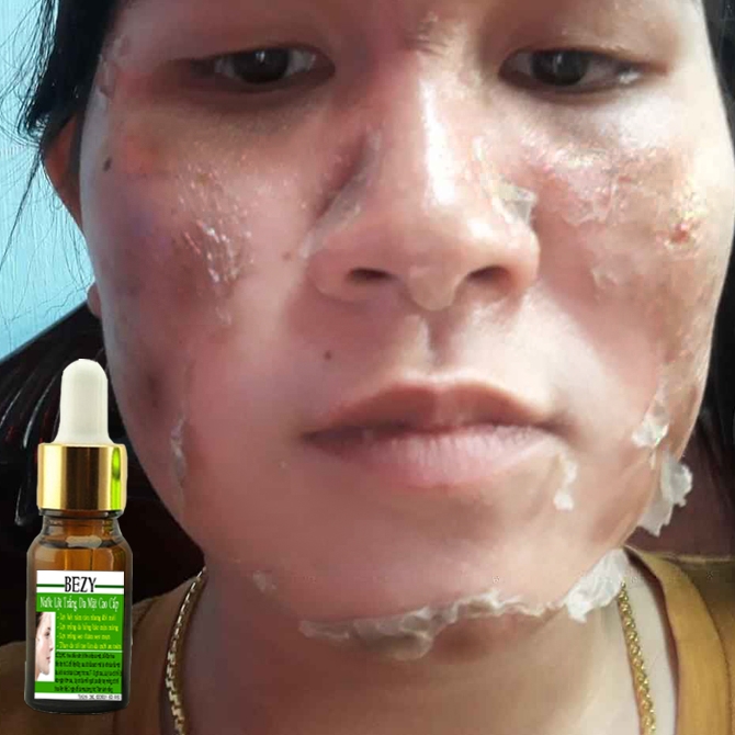 Lột thay da tái tạo xóa nám đen sạm trắng hồng