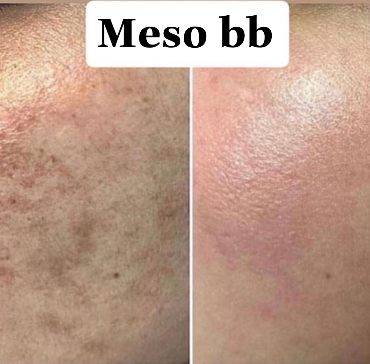 Cấy Phấn Trắng Da Hàn Quốc-Meso BB Brightening Control System