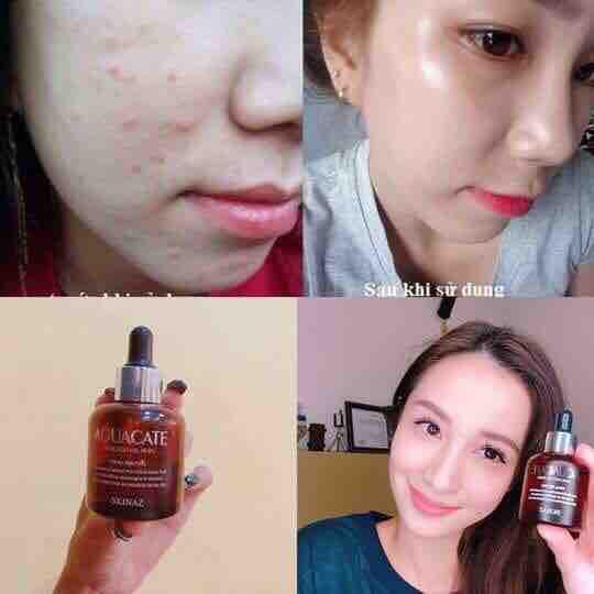 [HCM]Tinh chất bơ Skinaz Hàn Quốc