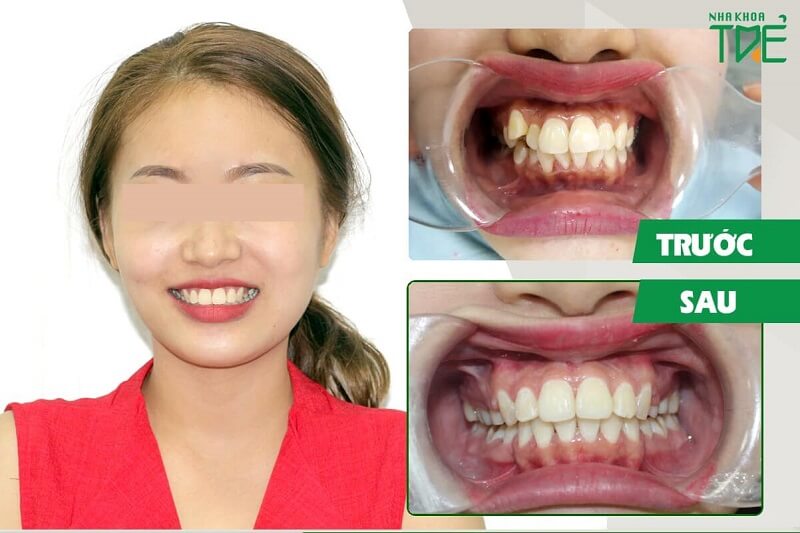 [HCM]Dụng cụ niềng răng trong suốt tại nhà Trainer COMBO [A1+A2+A3]