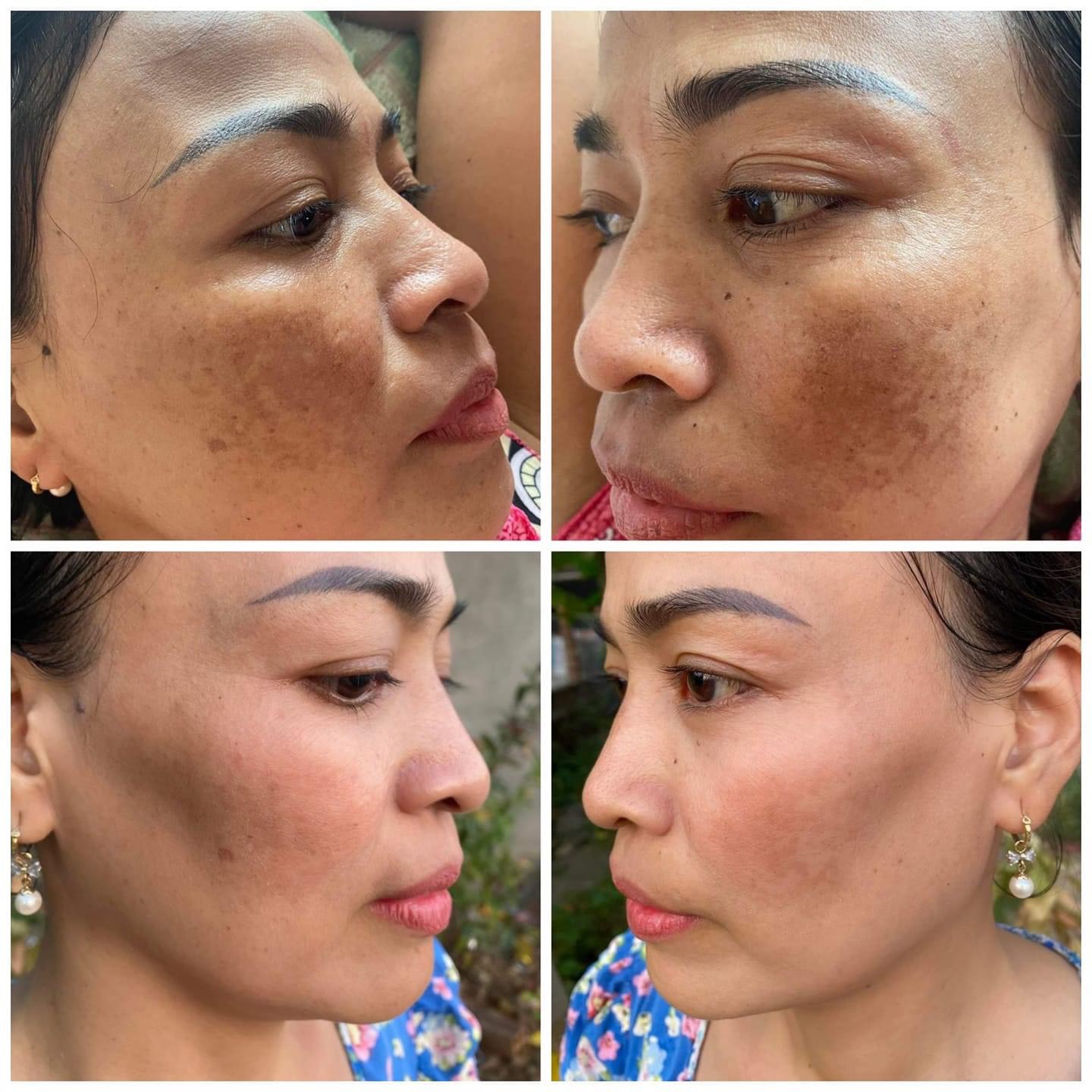 KEM FACE NANO DƯỠNG TRẮNG DA MỜ THÂM. THẢO MỘC SPA