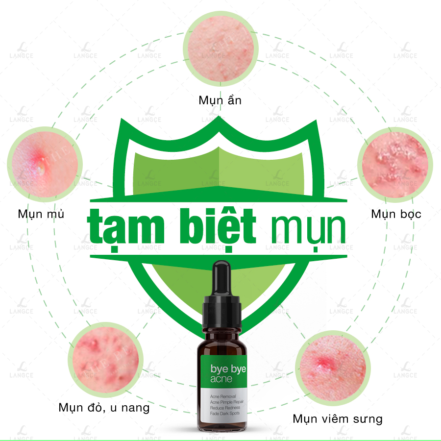 TẠM BIỆT MỤN BYE BYE BLEMISH for Acne LANGCE