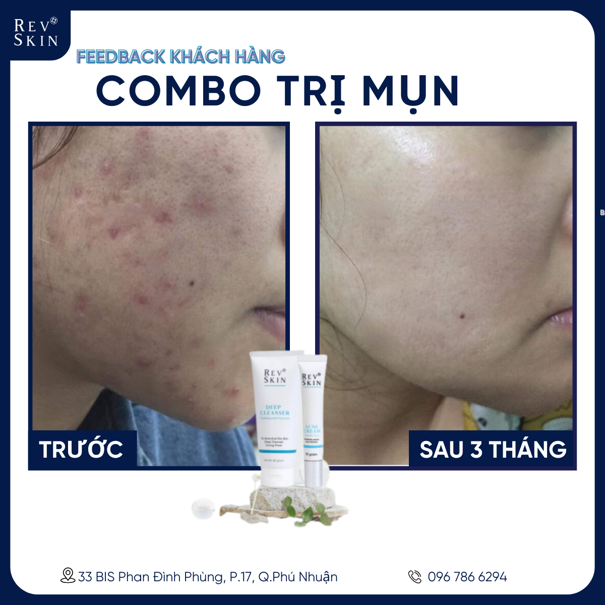 Sữa Rửa Mặt RevSkin Deep Cleanser Cho Da Dầu - Mụn - 60g