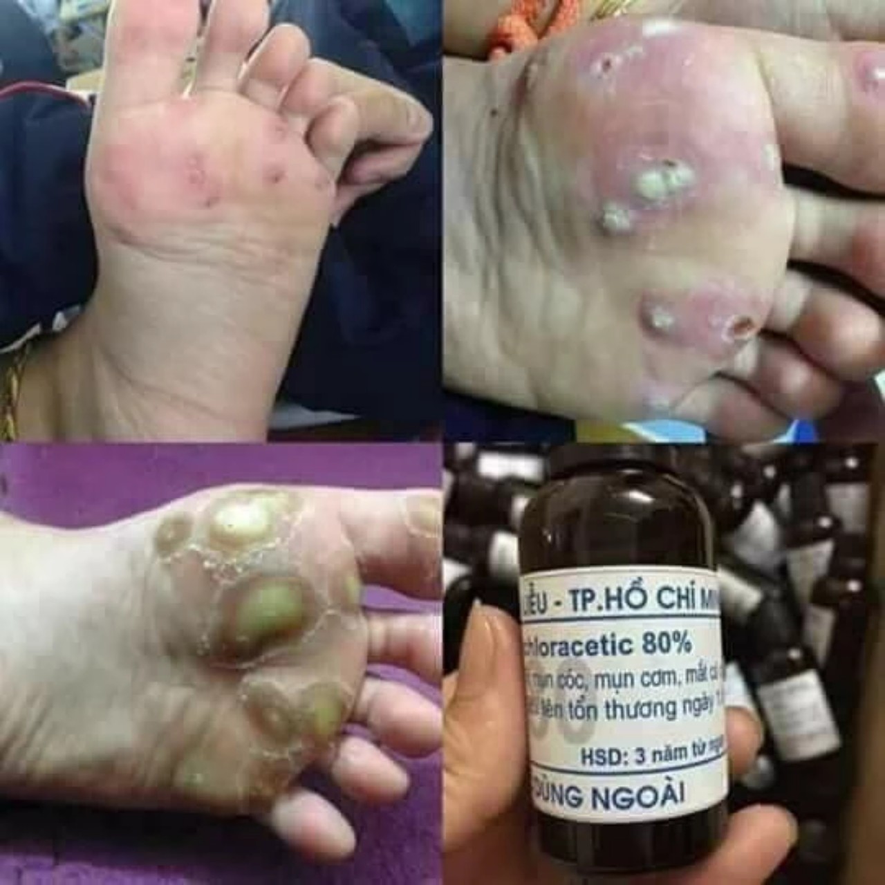 lọ tẩy mụn cóc, mụn cơm, nốt ruồi, mắt cá, mụn thịt cực hiệu quả