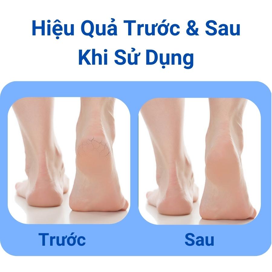 Bộ dụng cụ chăm sóc chân tẩy da chết